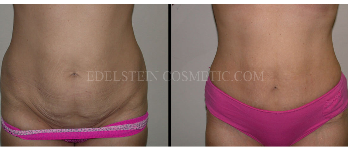 Tummy Tuck case #26600