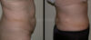 Tummy Tuck case #26599 slider thumbnail