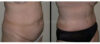 Tummy Tuck case #26599 slider thumbnail