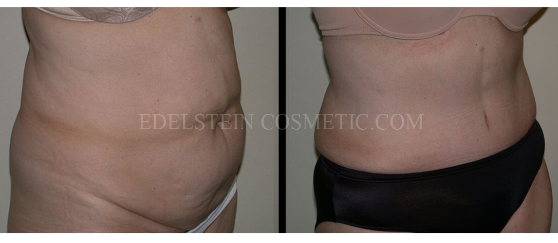 Tummy Tuck case #26599