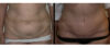 Tummy Tuck case #26599 slider thumbnail