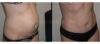 Tummy Tuck case #26598 slider thumbnail