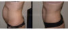 Tummy Tuck case #26598 slider thumbnail