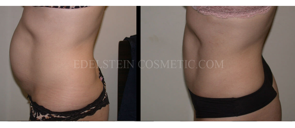 Tummy Tuck case #26598