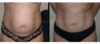 Tummy Tuck case #26598 slider thumbnail