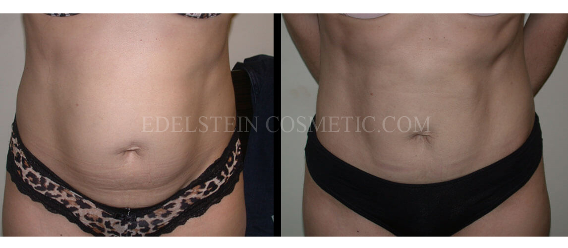 Tummy Tuck case #26598