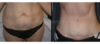 Tummy Tuck case #26597 slider thumbnail