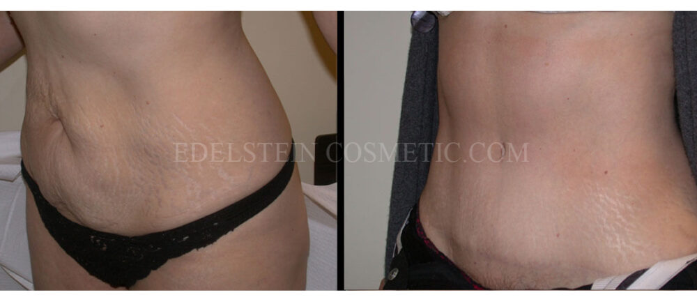 Tummy Tuck case #26597