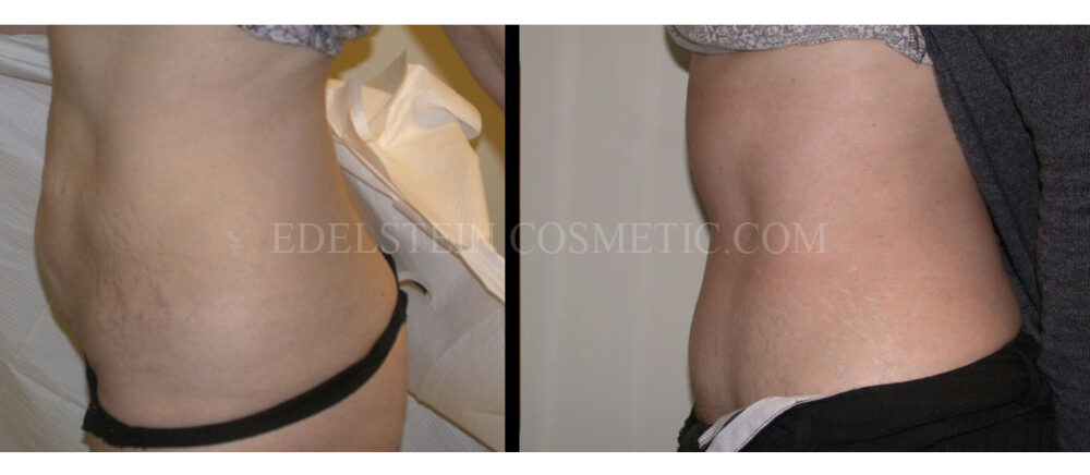 Tummy Tuck case #26597