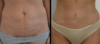 Tummy Tuck case #26596 slider thumbnail