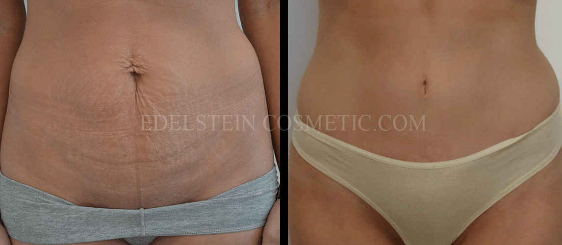 Tummy Tuck case #26596