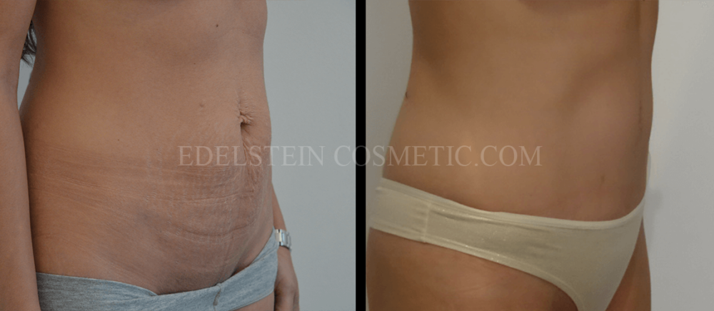 Tummy Tuck case #26596