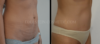 Tummy Tuck case #26596 slider thumbnail