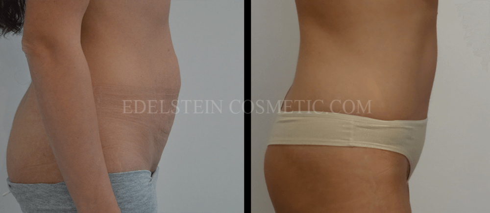 Tummy Tuck case #26596