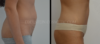 Tummy Tuck case #26596 slider thumbnail