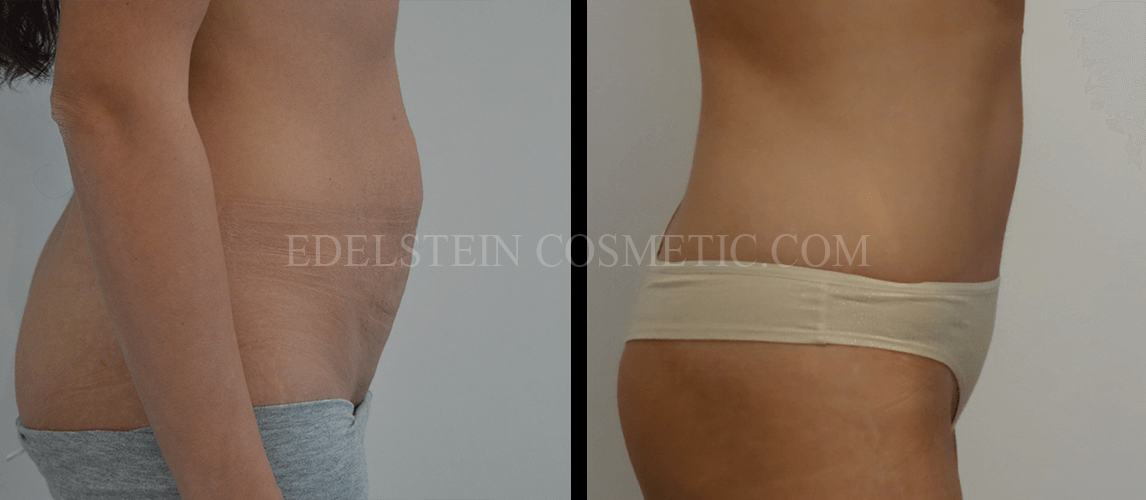 Tummy Tuck case #26596