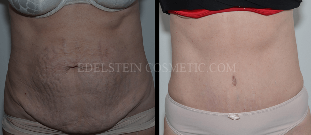 Tummy Tuck case #26595