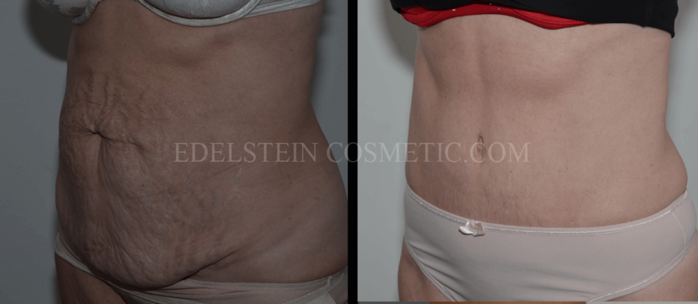 Tummy Tuck case #26595