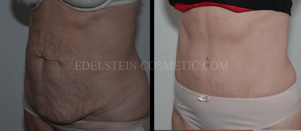 Tummy Tuck case #26595