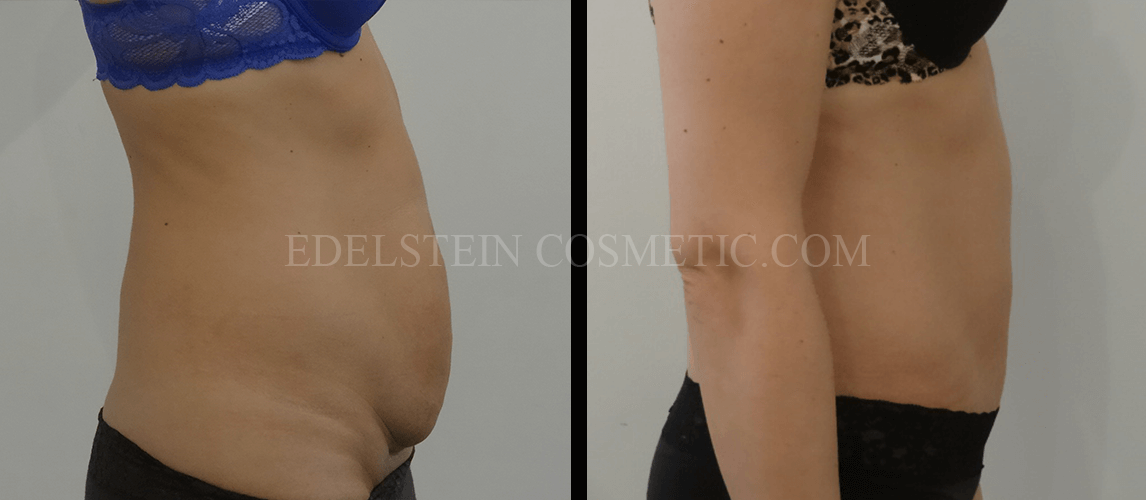 Tummy Tuck case #26594