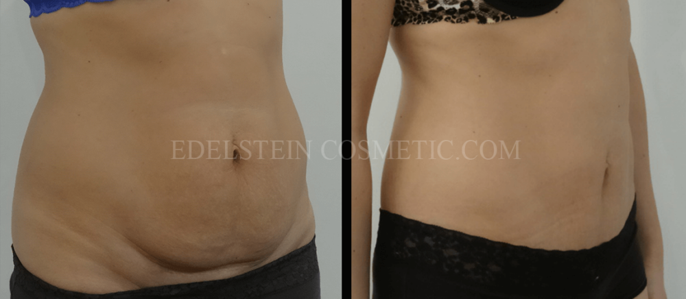 Tummy Tuck case #26594