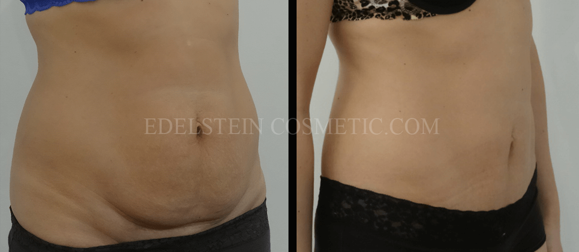 Tummy Tuck case #26594