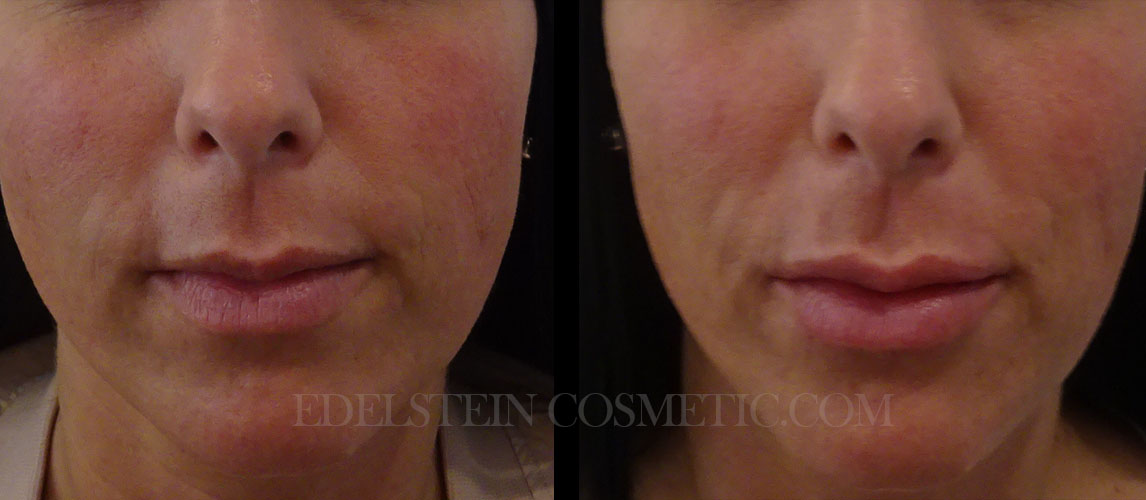 Lip Enhancement case #26709