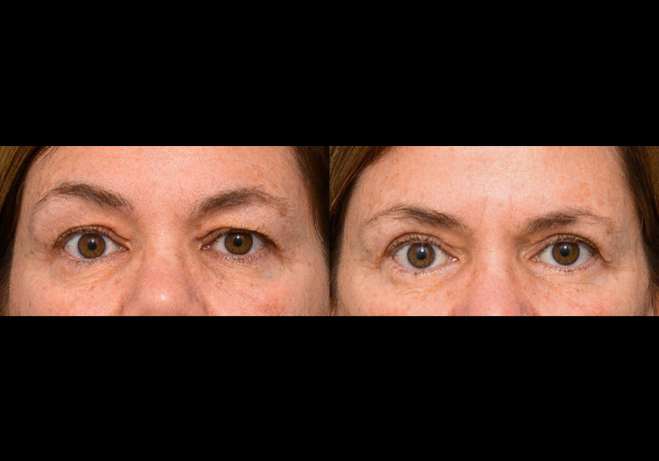 Blepharoplasty case #26812