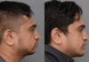 Chin Augmentation case #26832 slider thumbnail