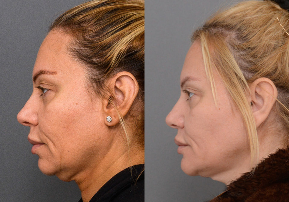 Chin Augmentation case #26831