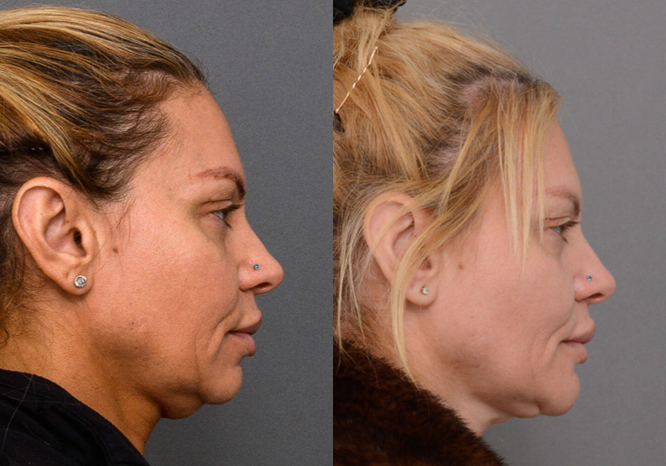 Chin Augmentation case #26831