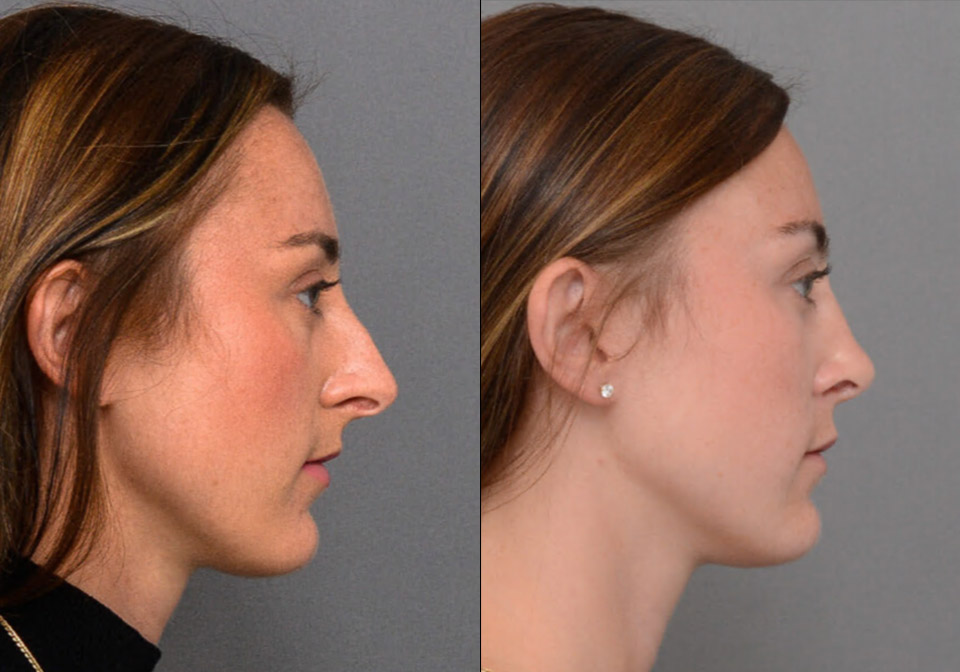 Primary Rhinoplasty case #26796