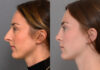 Primary Rhinoplasty case #26796 slider thumbnail