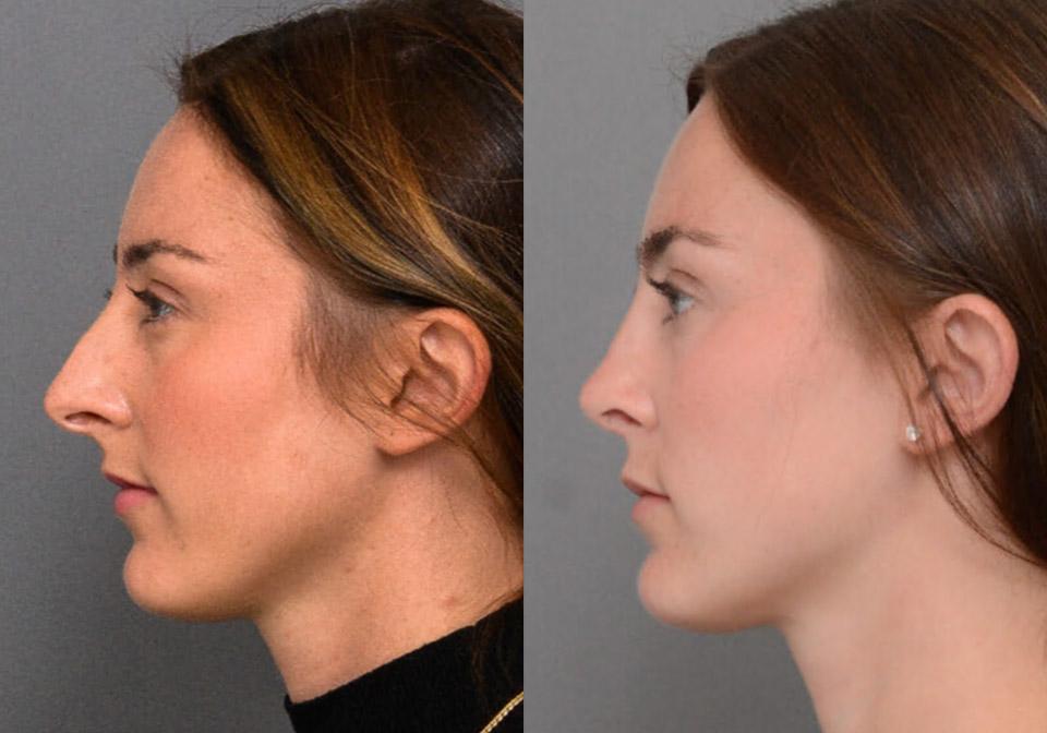 Primary Rhinoplasty case #26796