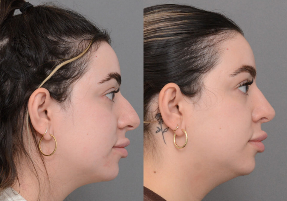 Primary Rhinoplasty case #26794