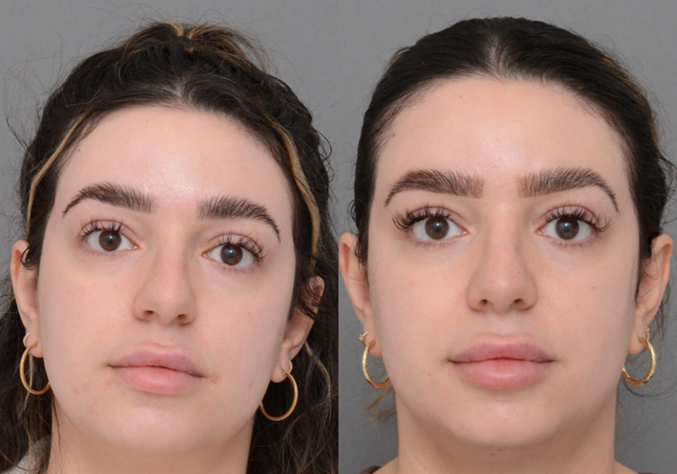 Primary Rhinoplasty case #26794