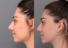 Primary Rhinoplasty case #26792 slider thumbnail