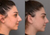 Primary Rhinoplasty case #26792 slider thumbnail