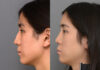 Primary Rhinoplasty case #26790 slider thumbnail