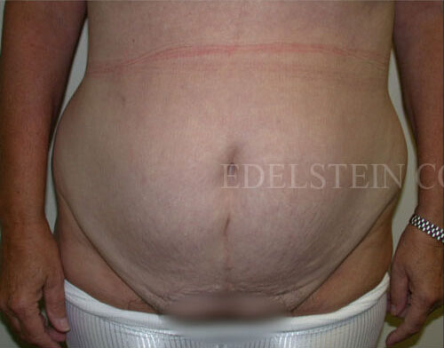 tummy-tuck-toronto-before-after-p031-1000x436_0000_Layer 0 copy