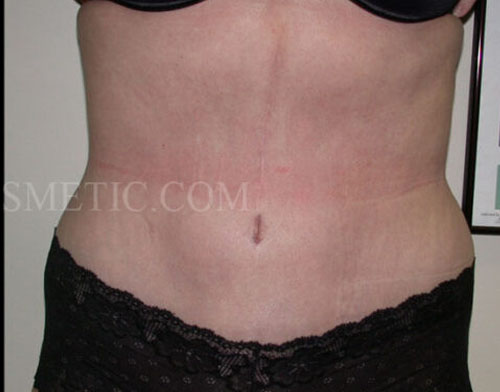 tummy-tuck-toronto-before-after-p031-1000x436_0001_Layer 0