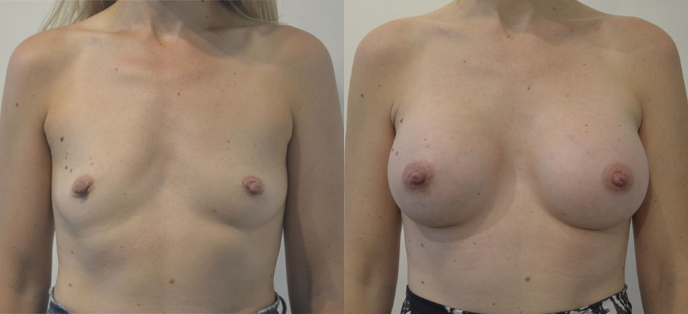 Breast Augmentation case #28314