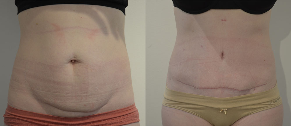 Tummy Tuck case #28311