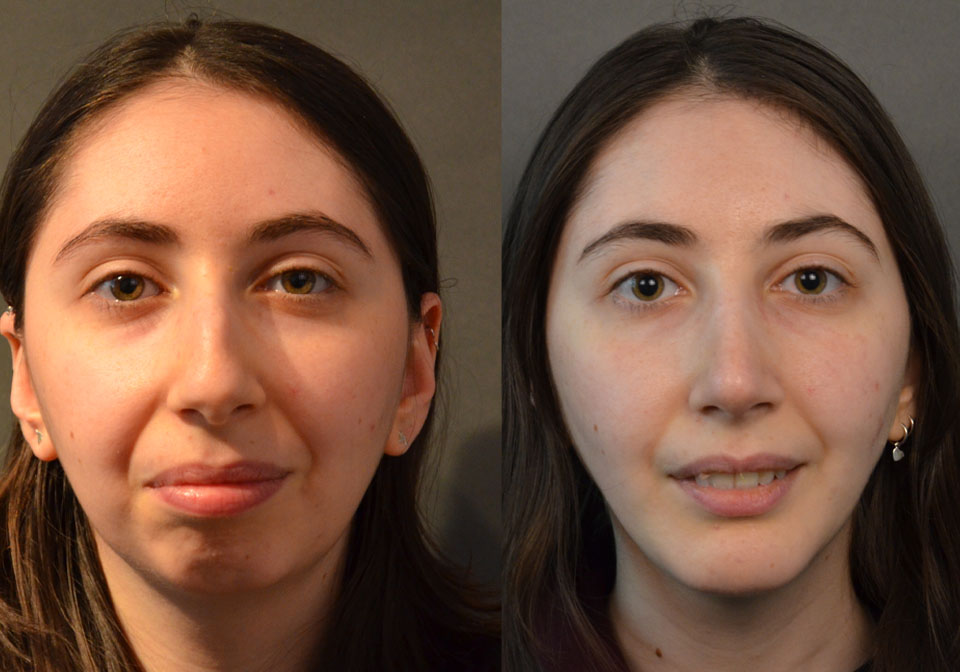 Primary Rhinoplasty case #28241