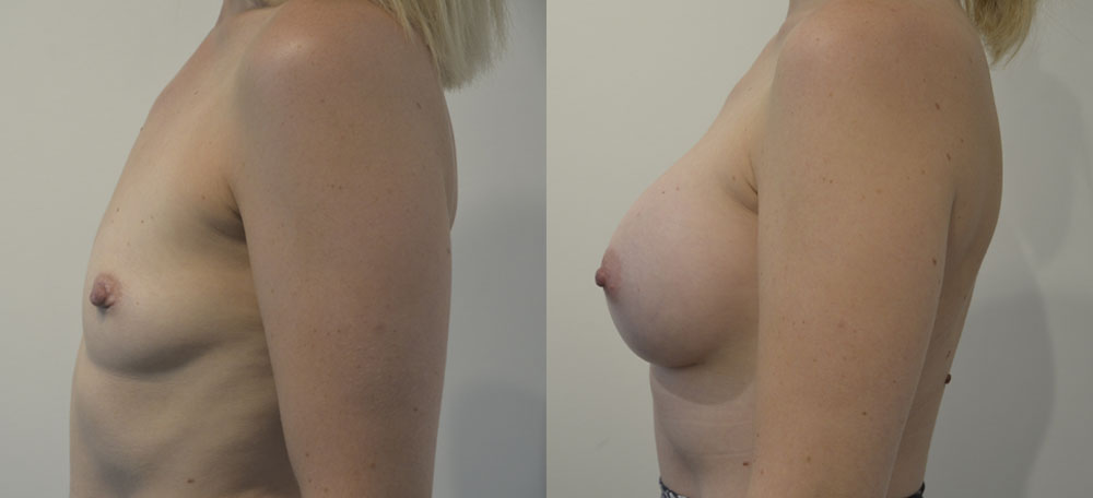 Breast Augmentation case #28314