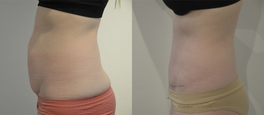 Tummy Tuck case #28311