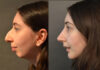 Primary Rhinoplasty case #28241 slider thumbnail