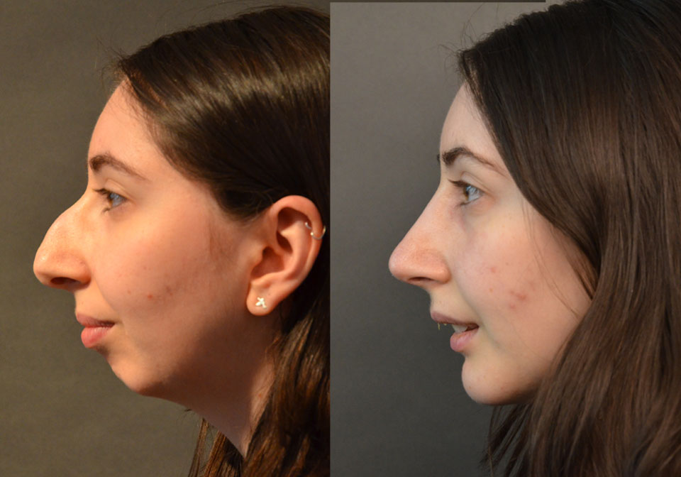 Primary Rhinoplasty case #28241