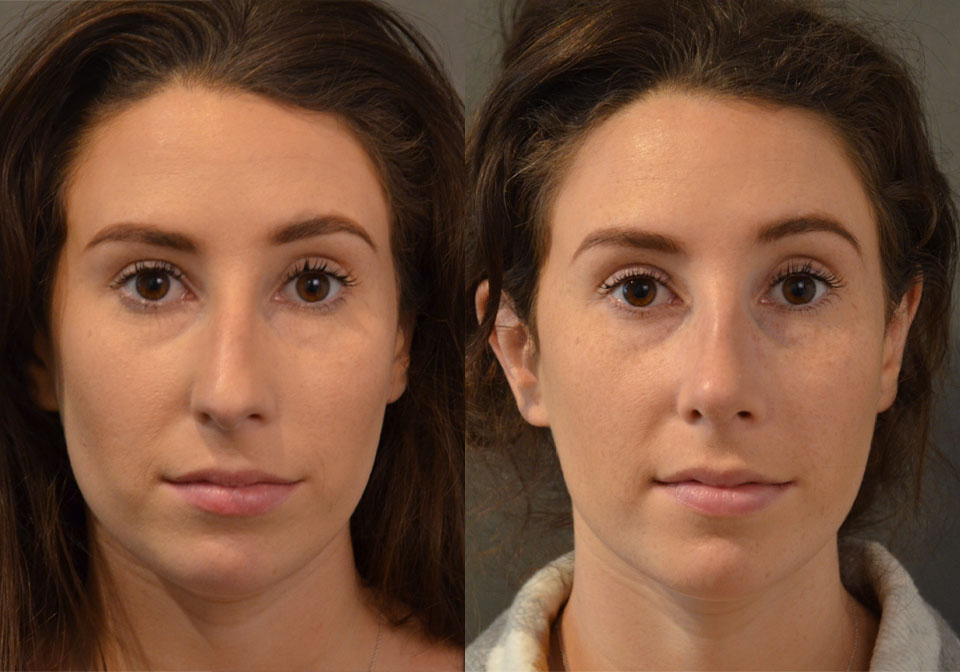 Primary Rhinoplasty case #28255