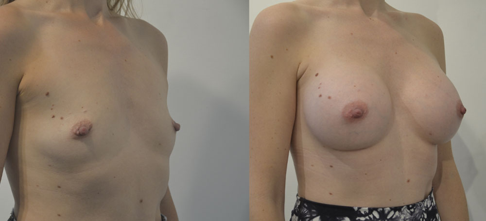 Breast Augmentation case #28314